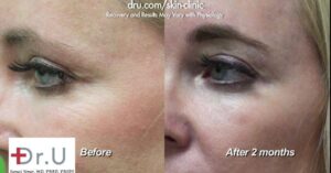 Botox for crows feet helped eliminate static lines.