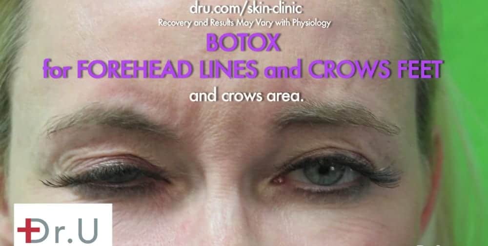 Patient before her Botox for crows feet treatment.