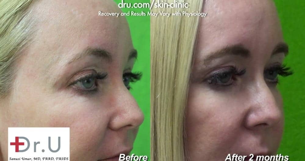 Botox patient before and after crows feet.*