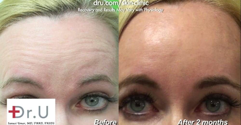 How many units of Botox are needed for the forehead area? Schedule a free consultation with our office for more information.*