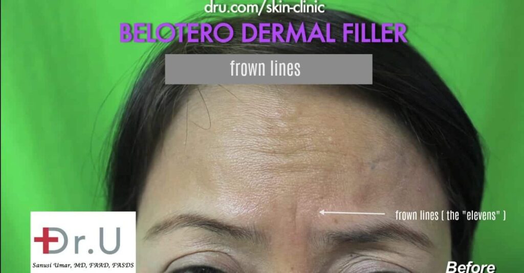 Manhattan Beach, Los Angeles patient, wants to get rid of frown lines with Belotero. Manhattan Beach, Los Angeles patient wants to get rid of frown lines with Belotero.