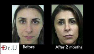 At two months, the hyaluronic acid laugh lines filler continues to produce natural looking results.*