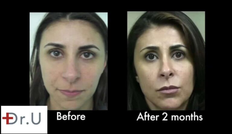 At two months, the hyaluronic acid laugh lines filler continues to produce natural looking results.*