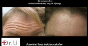 Botox helped El Segundo patient achieve a smoother forehead.