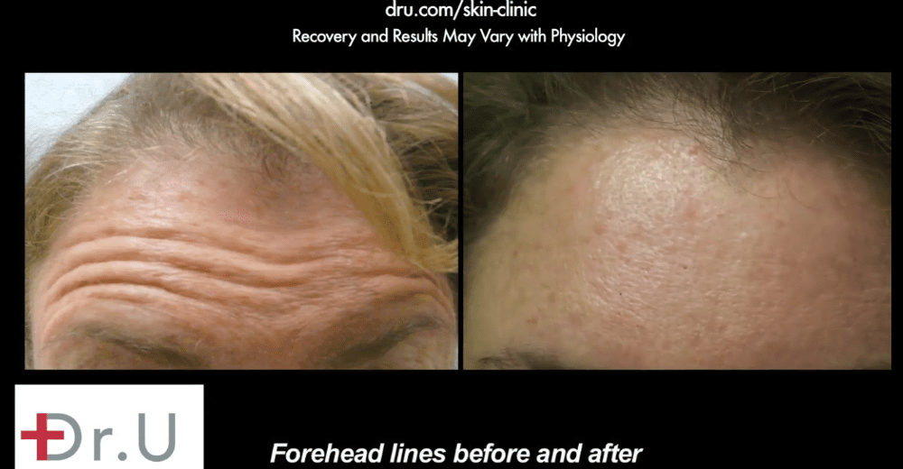 Botox helped El Segundo patient achieve a smoother forehead.