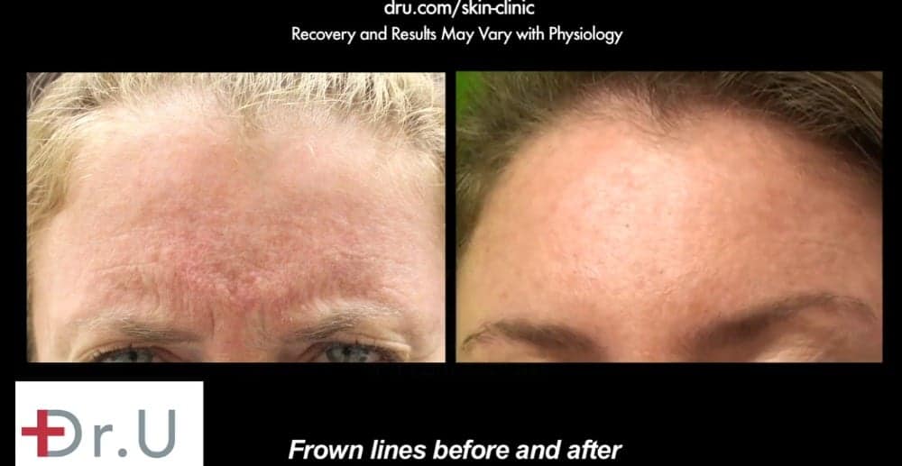 Many patients wonder, "is Botox safe for crows feet?". Your dermatologist can go over your concerns in an initial consultation. This patient was happy wih how Dr. U used Botox to rejuvenate the glabellar region by targeting the patient's frown line wrinkles.*