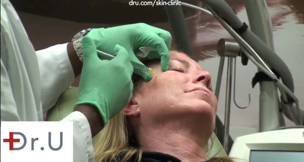 Dr. U injects Botox for crows feet around the eyes