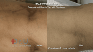 Close up view of Dr. U patient result after varicose vein removal. While spider veins on legs are more common, they can also appear on other parts of the body, such as the forearm.