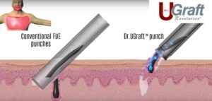 A Dr.UGraft ™ hair transplant with a natural hairline is able to use grafts from the leg, nape or other area of the body using specialized technology.