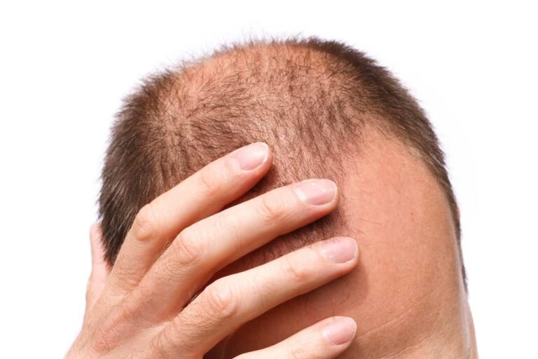 Bad hair transplant scars can affect one's psyche, possibly preventing them from pursuing linear-scar free hair transplant procedures.