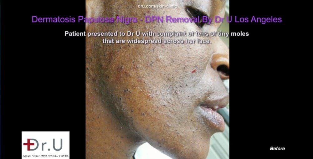 Photos of Westchester, Los Angeles patient show numerous black skin tags on the face and neck.* Photos of Westchester, Los Angeles patient show numerous black skin tags on the face and neck.*