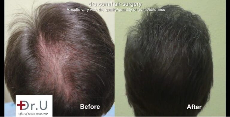 Results like these before and after photos have earned Dr.U many positive natural hair transplant reviews.