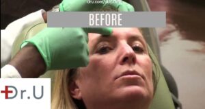 El Segundo, Los Angeles patient before Botox for eyebrow lift, crows feet, frown lines & forehead wrinkles.