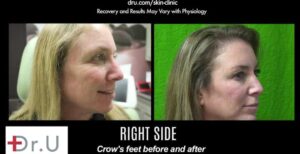 Right side of treatment results using Botox for crows feet around the eyes.