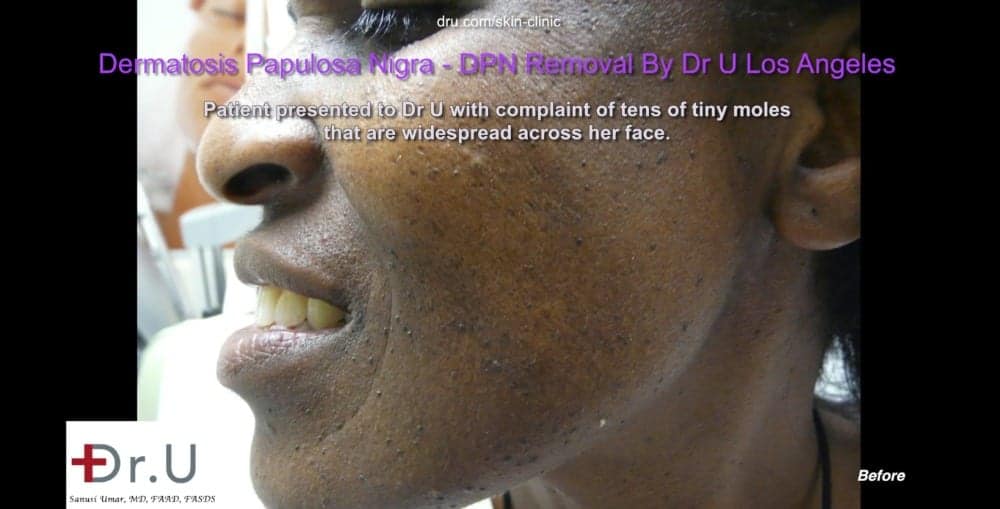 The appearance of black skin tags on the face and neck is due to Dermatosa Papulosa Nigra which develop over time due to genetic and environmental influences.* The appearance of black skin tags on the face and neck is due to Dermatosa Papulosa Nigra which develop over time due to genetic and environmental influences.*