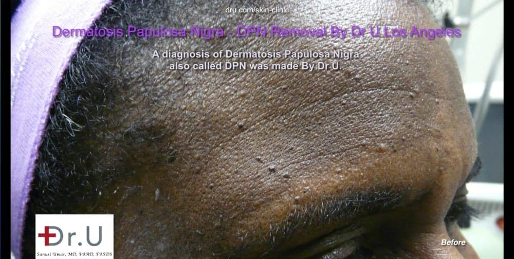 Black skin tags on the face and neck across the patient's forehead.* DPN lesions which look like skin tags on the face appear across patient's forehead.