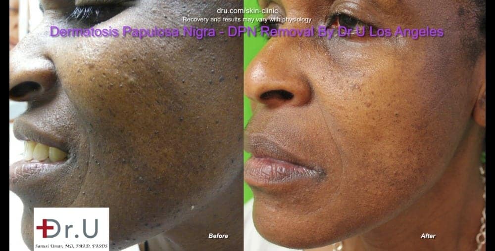 Left side comparison photos show a major clearance of black skin tags on the face.* Left side comparison photos show a major clearance of black skin tags on the face.*