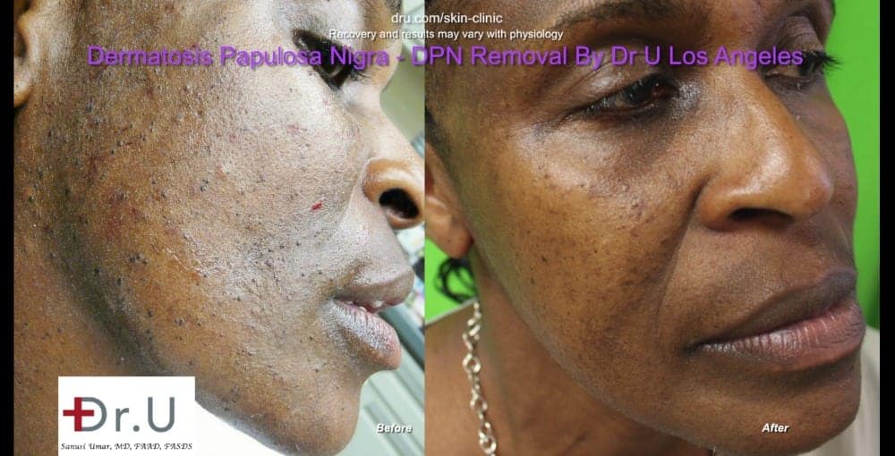Dermatosa Papulosa Nigra pictures show smoother skin following Dr.U's treatment.* Dermatosa Papulosa Nigra pictures show smoother skin following Dr.U's treatment.*