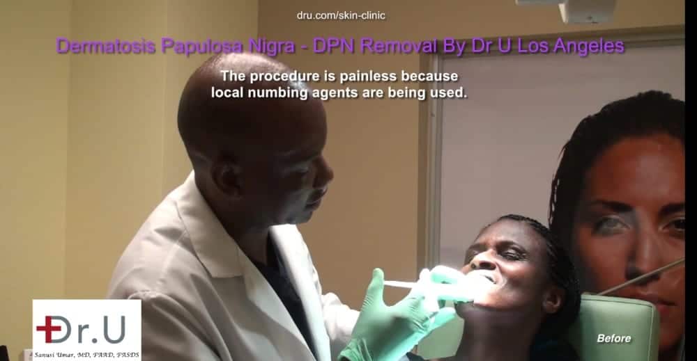 Dr. U uses low current electrocautery to remove black skin tags on the face and neck. The technique can also be used for general skin tags on the face.* Dr. U uses low current electrocautery to remove black skin tags on the face and neck. The technique can also be used for general skin tags on the face.*