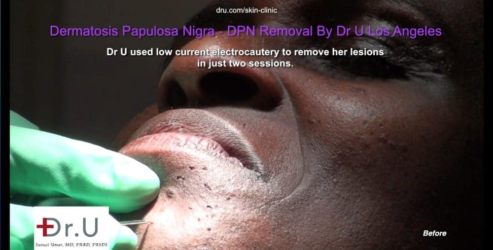 Electrocautery burns and seals blood vessels which feed DPN lesions which look like dark skin tags on the face.* Electrocautery burns and seals blood vessels which feed DPN lesions which look like dark skin tags on the face.*