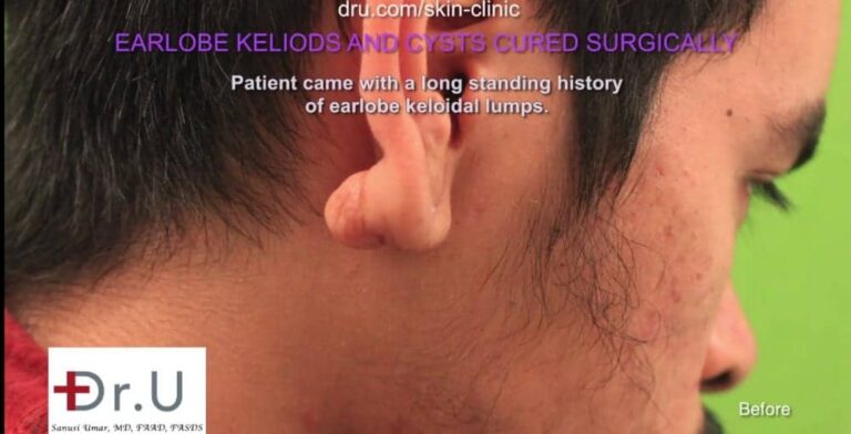 Long Beach, Los Angeles patient with keloid cyst in the ear.