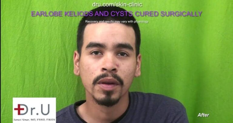 Patient's left and right ear appear similar to one another after Dr. U keloid cyst removal