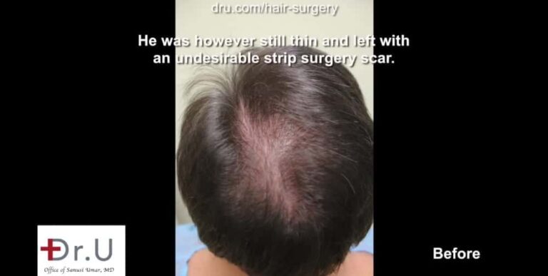 Patient not only hopes for a hair transplant with a natural hairline, but also coverage for the areas of failed growth.