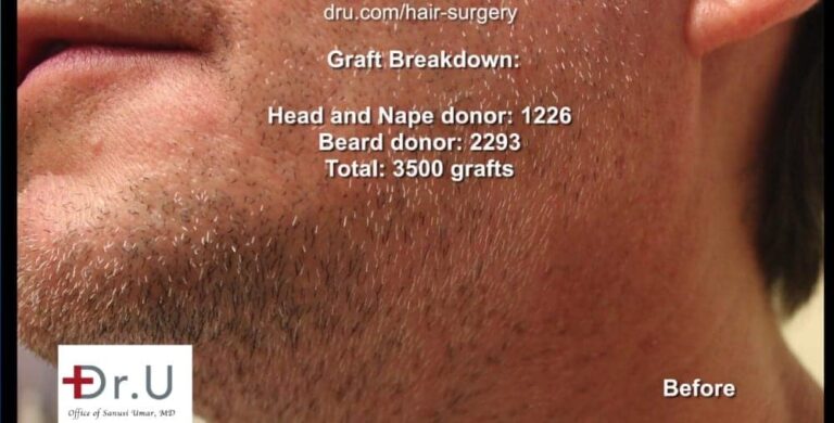 The Dr.UGraft™ undetectable hairline transplant and repair procedure required 3500 grafts.