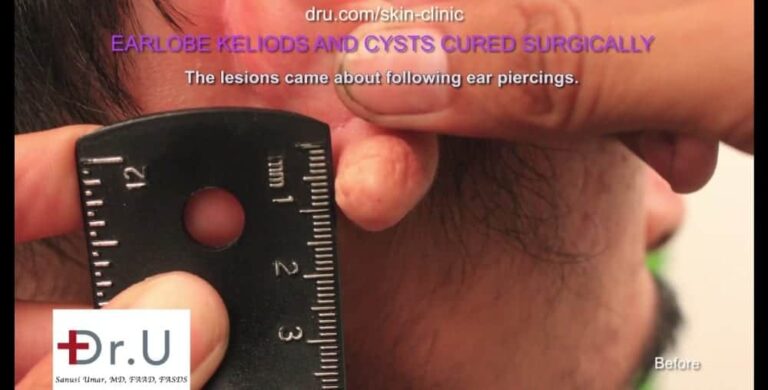 Dr. U measures patient's keloid cyst prior to removing it through surgery.