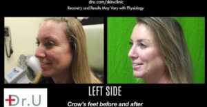 Left side of treatment results using Botox for crows feet around the eyes.