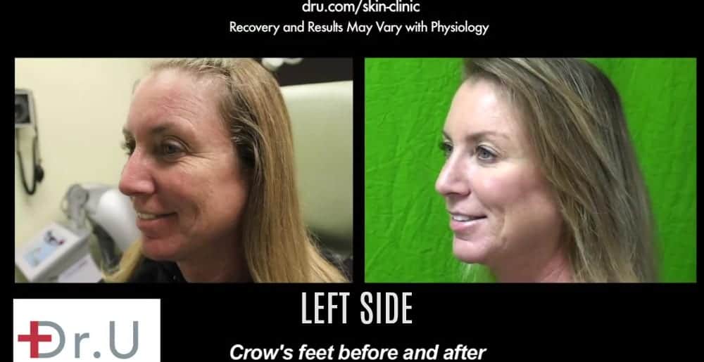 Left side of treatment results using Botox for crows feet around the eyes.