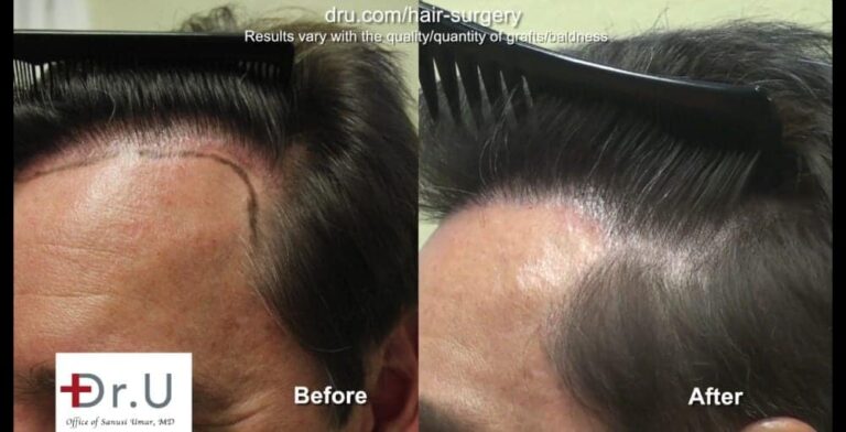 A Dr.UGraft™ undetectable hairline transplant focuses on intricate details for the temple region.