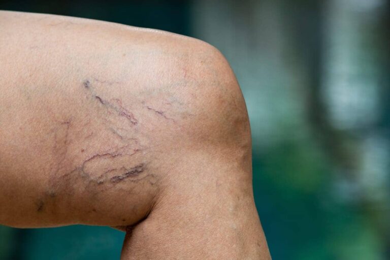 For spider veins on legs with are greater than 3 mm in width, laser removal may not be effective. For this reason, Dr. U recommends sclerotherapy for large varicose veins in the leg.