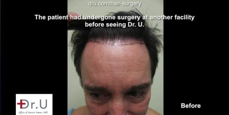 Torrance, Los Angeles patient before his Dr.UGraft™ undetectable hairline transplant.