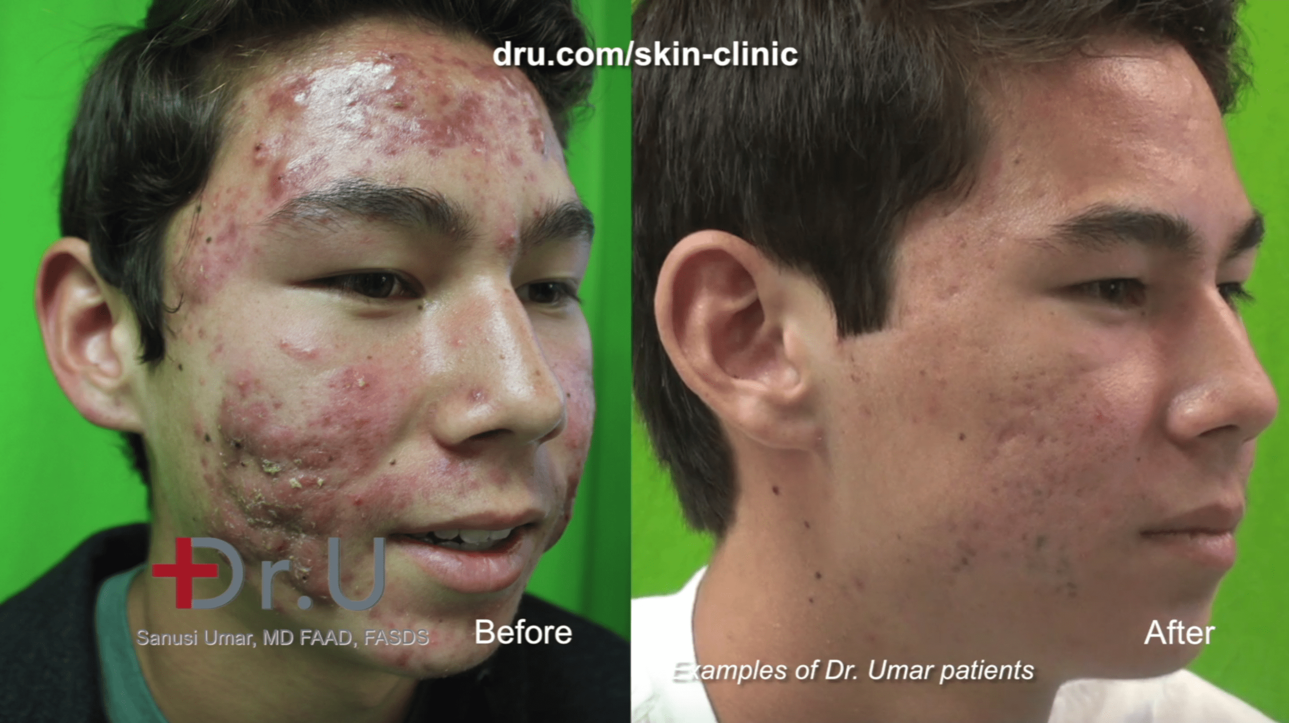 The result of PDT laser treatment for acne at Dr. U Skin Clinic.*