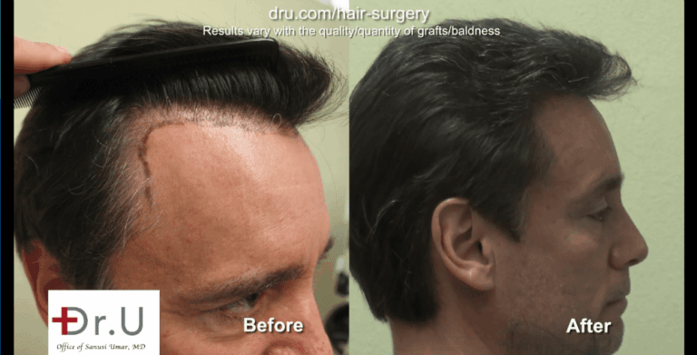 A hair transplant with a natural hairline must focus on the transition of the temples.