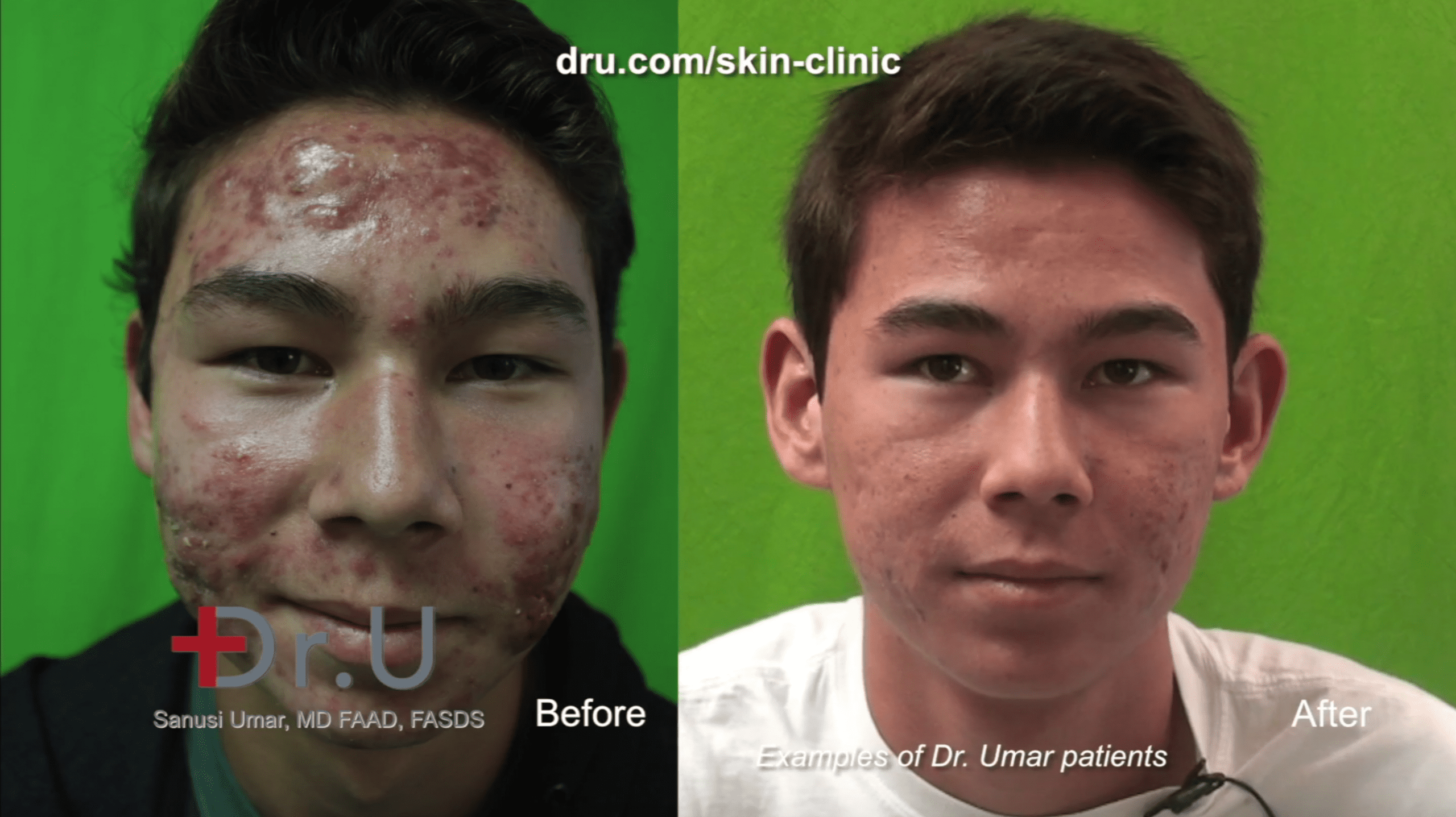 This minor patient’s parents opted for severe acne laser treatment over Accutane. PDT laser therapy yielded excellent results.*