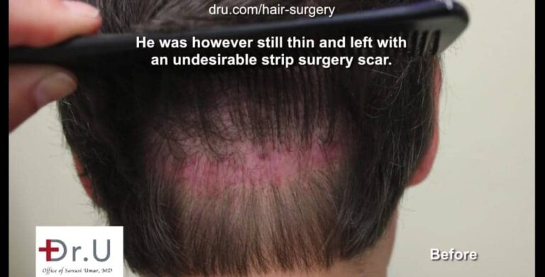Many people ask, "does a hair transplant look natural" after a strip surgery with a large, obvious scar remaining