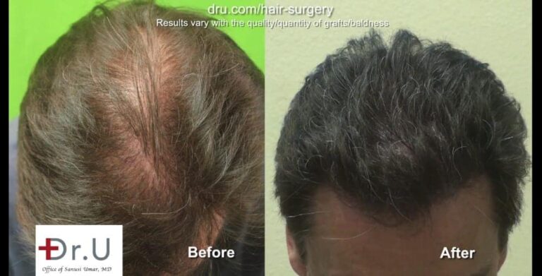 Does a hair transplant look natural? Dr.U's results show that the answer to this question is a resounding yes.