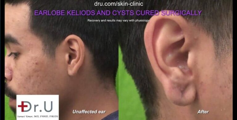 Comparison of earlobe affected by keloid cyst with the unaffected ear.