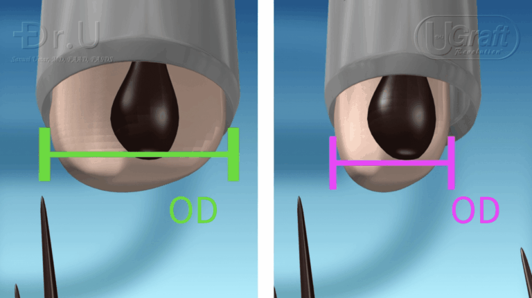 In this photo, the relationship between FUE punch diameter and graft size is illustrated clearly.