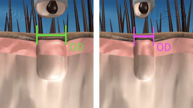 Naturally, the more tissue collected along with the follicle itself, the bigger the hole left behind by the FUE punch will be.