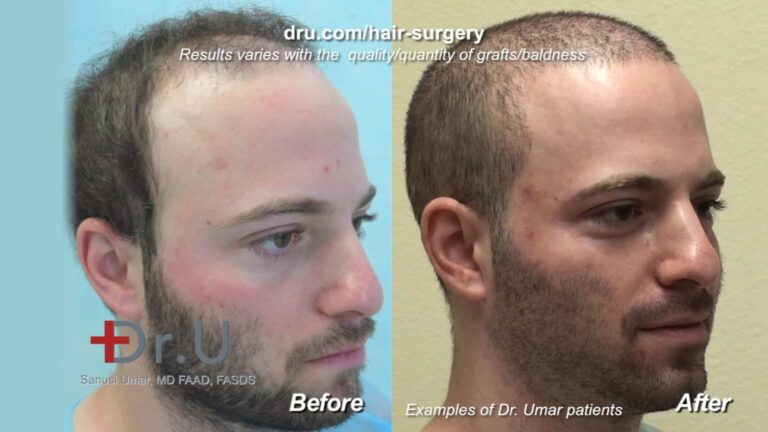 Los Angeles hair loss sufferers are encouraged to evaluate before and after photos of patients (preferably as similar as possible to their own case) to better understand what to expect from a hair transplant performed by a specific provider 