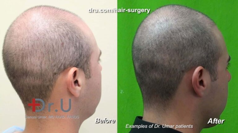 Case studies of specific patients help shed light on what it is like to get a hair transplant, especially if they provide their own testimonial feedback, in addition to their side by side comparison photos 