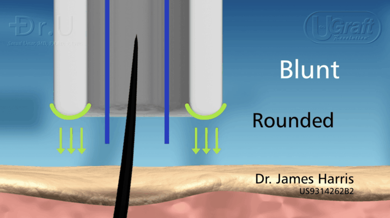 Rounded FUE punch tips such as this one have the ability to protect the graft from accidental transection.