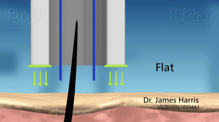 Blunt FUE punches with flat rims feature cutting surfaces perpendicular to the skin.