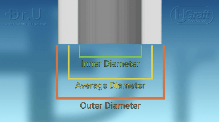 The inner diameter, the average diameter, and the outer diameter of the FUE punch tip all influence the performance of the FUE punch.