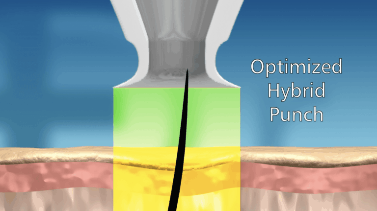 The Dr.UPunch i™ intelligent FUE punch tip is optimized to collect an abundant and bulky graft while imposing the least-intrusive punch wound possible.