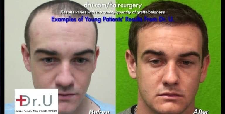 Young Patient Hair Transplant - Dr. U Skin & Hair Clinic V1