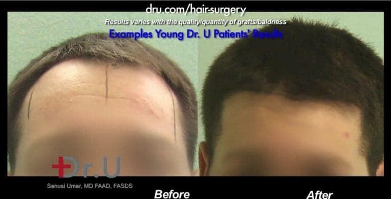 What is the best age to get a hair transplant surgery? The right age for hair transplant surgery will differ for each patient